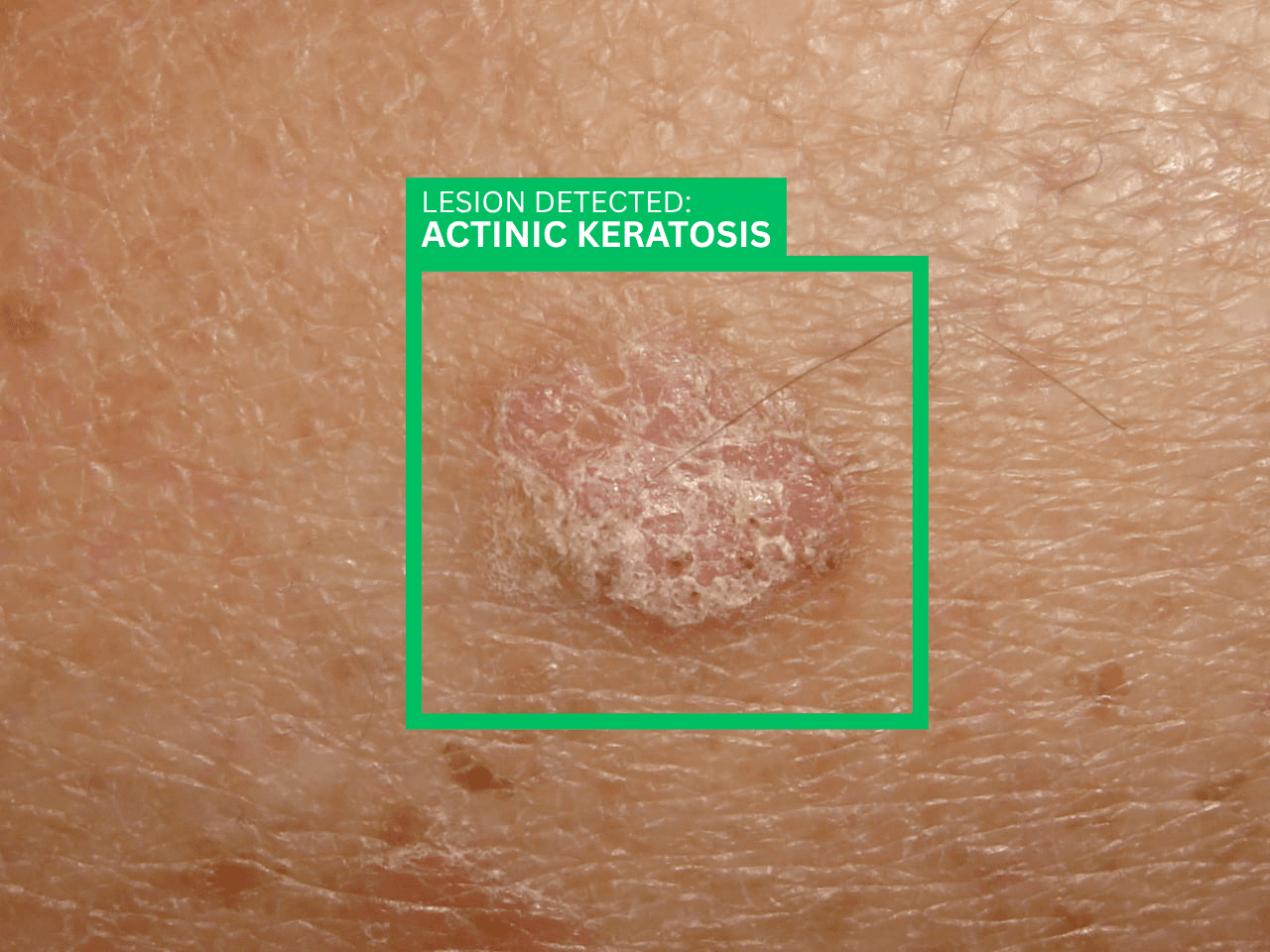 Clinical reference photo of an actinic keratosis lesion on sun-damaged skin.