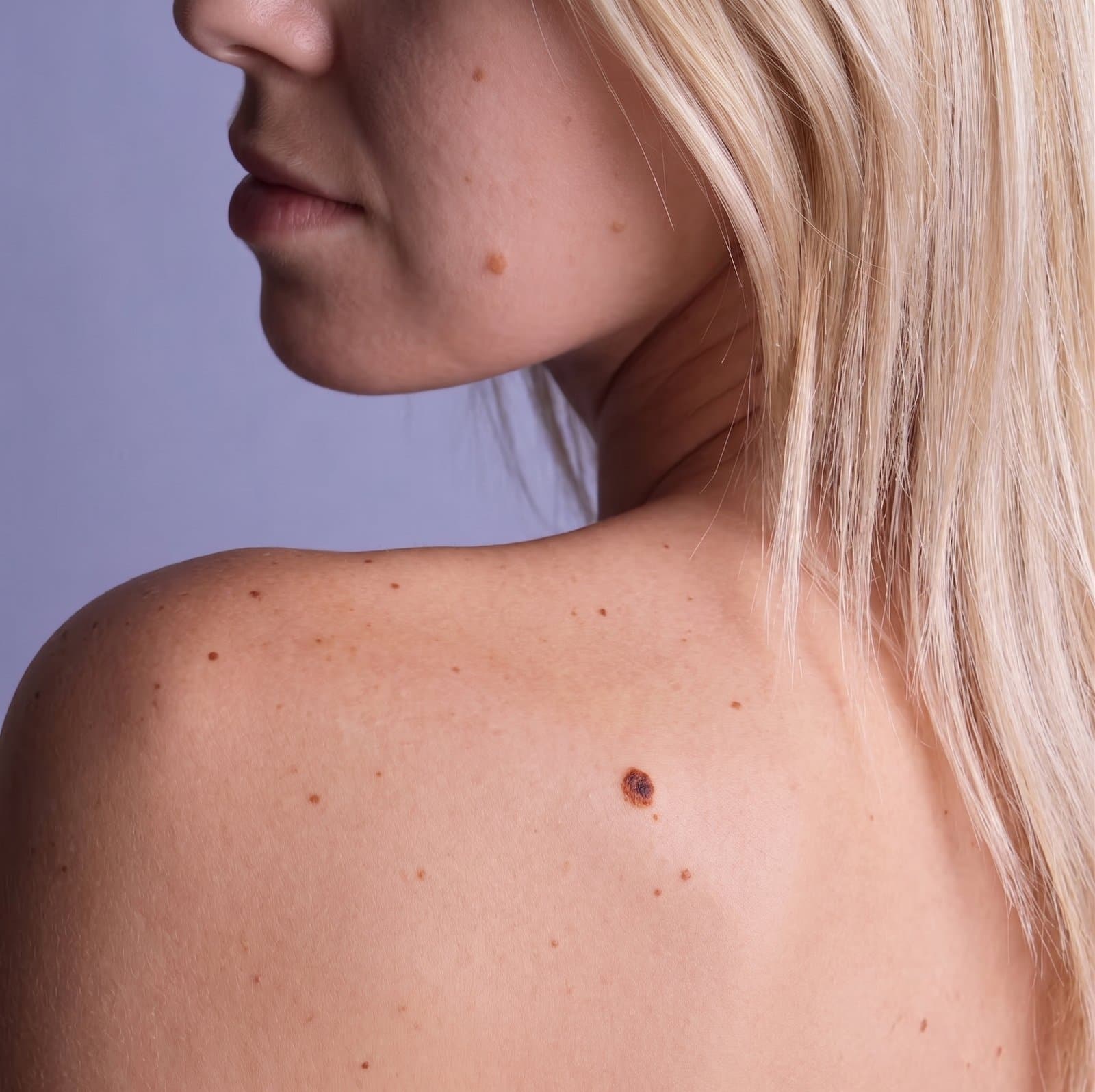 A clinically framed photograph of a back lesion captured with the SkinMD iOS app.